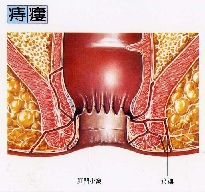 膿瘍 肛門 周囲 肛門周囲膿瘍(こうもんしゅういのうよう)